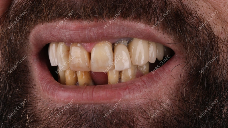 Severe Tooth Decay
